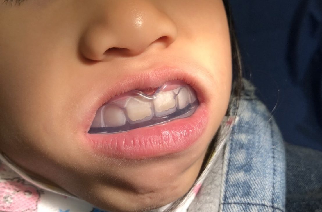 隱適美兒童牙齒矯正　高雄牙齒矯正推薦─永馨牙醫診所 呂靖雯醫師